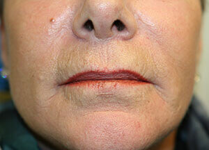 Lip Lift After